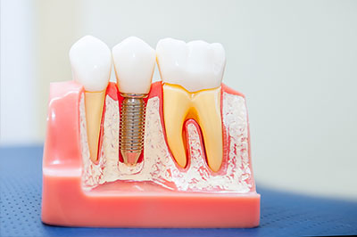 Dental Implants 06360