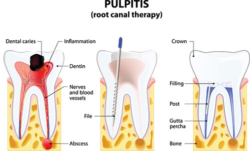 Root Canal Treatment 06360