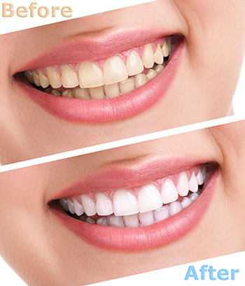Teeth Whitening Norwich